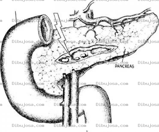 Dibujo para colorear Cancer De Pancreas Lamina Para Colorear Y Pintar