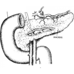Dibujo para colorear Cancer De Pancreas Lamina Para Colorear Y Pintar