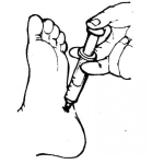 Dibujo para colorear Dibujo De Inyeccion En El Pie Para Pintar Y Colorear Pie Inyectado Con Anestesia