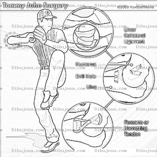 Dibujo para colorear Tommy John Surgery Lamina Informativa De La Cirugia De Tommy John Para Pintar Y Colorear
