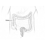 Dibujo para colorear Colonoscopia Dibujo Del Examen De Colon por colon irritable para detectar y tratar cancer de colon o enfermedades del colon Para Pintar Y Colorear antes del remicade