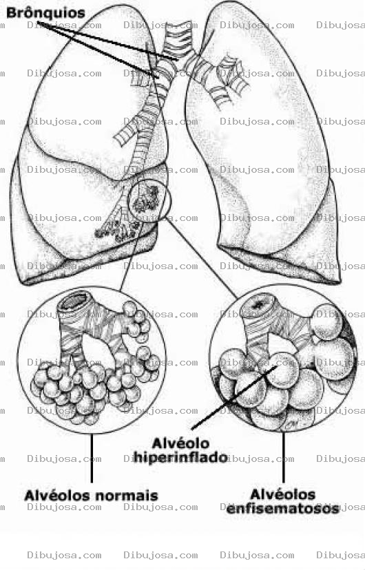 Dibujo para colorear Efisema Pulmonar Enfermedades Por Fumar Cigarrillos De Tabaco Dibujp De Bronquios Para Entender Enfermedades En Los Alveolos Para Pintar Y Colorear