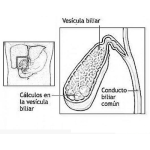 Dibujo para colorear Calculos En La Vesicula Biliar Dibujo Para Ver La Ubicacion De La Vesicula Y Ver Las Piedras De La Besicula Viliar Que Segrega La Bilis Para Pintar Y Colorear