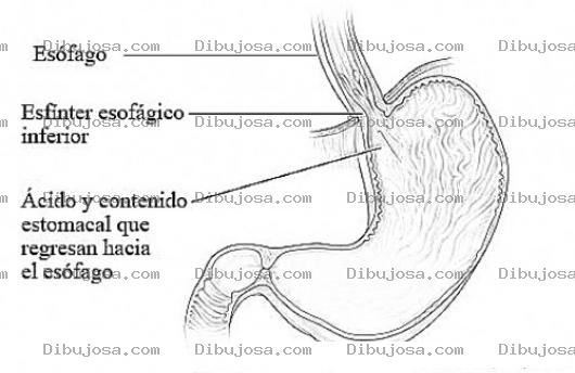 Dibujo para colorear Reflujo Gastroesofagico Dibujo Del Reflujo Gastrico Para Pintar Y Colorear Acido Estomacal En El Esofago Que Quema La Garganta