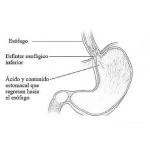Dibujo para colorear Reflujo Gastroesofagico Dibujo Del Reflujo Gastrico Para Pintar Y Colorear Acido Estomacal En El Esofago Que Quema La Garganta