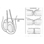 Dibujo para colorear Reversion De Vasectomia Dibujo Para Entender La Reversion De La Basectomia Para Eyacular Nuevamente Y Volver A Ser Fertil
