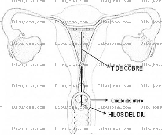 Dibujo para colorear Metodo Anticonceptivo TdeCobre Conocido Como DIU Dibujo De La T De Cobre Para Pintar Y Metodo Para Evitar Embarazos
