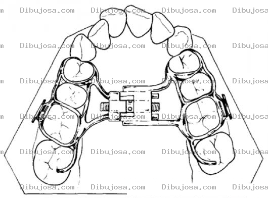 Dibujo para colorear Frenos Dentales Dibujo De Dentadura Con Brackets Internos Para Pintar Y Colorear Correcion Dental