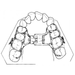 Dibujo para colorear Frenos Dentales Dibujo De Dentadura Con Brackets Internos Para Pintar Y Colorear Correcion Dental