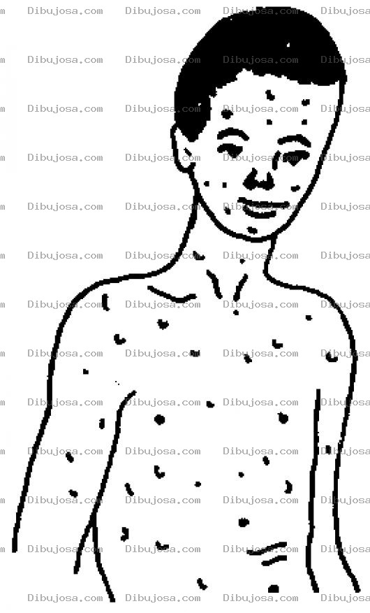 Dibujo para colorear Varicela Dibujo De Chico Con Varisela Para Pintar Y Colorear La Enfermedad De La Barisela Baricela Con Sarampion