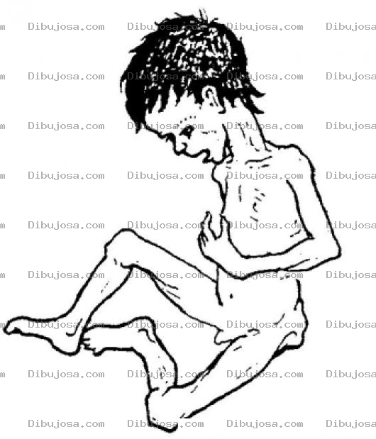 Dibujo para colorear Desnutricion En Jocotan Dibujo De Nino Desnutrido Y Con Hambre Para Pintar Y Colorear Somalia O Jocotan