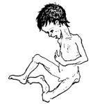 Dibujo para colorear Desnutricion En Jocotan Dibujo De Nino Desnutrido Y Con Hambre Para Pintar Y Colorear Somalia O Jocotan