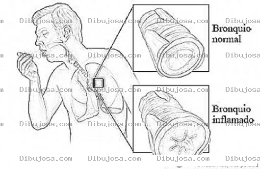 Dibujo para colorear Bronquios Inflamado Para Pintar Y Colorear Enfermedad Pulmonar Dibujo De Pulmones Enfermos