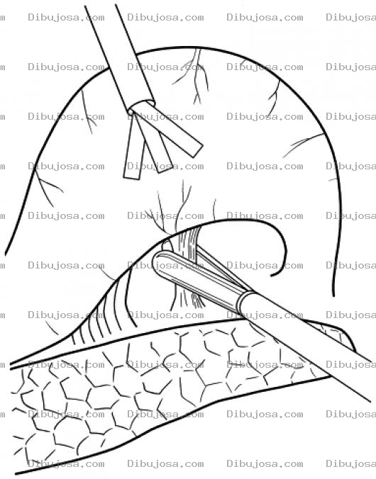 Dibujo para colorear Operacion Laparoscopica Para Pintar Y Colorear Procedimiento Quirurgico Moderno