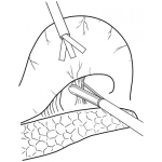 Dibujo para colorear Operacion Laparoscopica Para Pintar Y Colorear Procedimiento Quirurgico Moderno